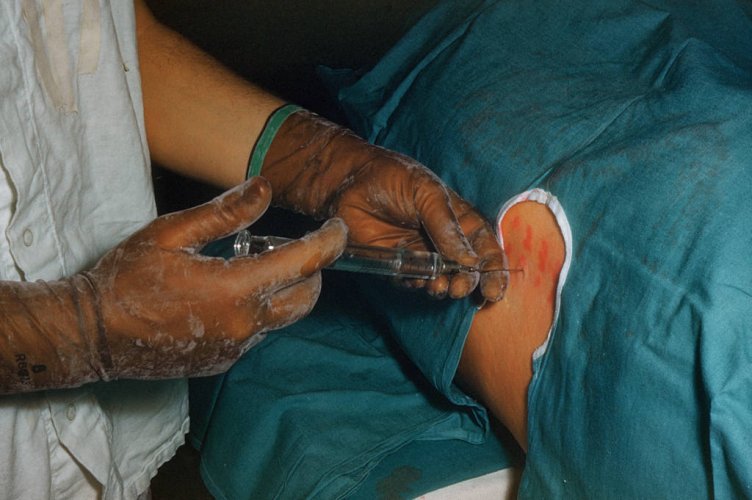  Saiba quais os tipos de anestesia e quando são mais recomendadas